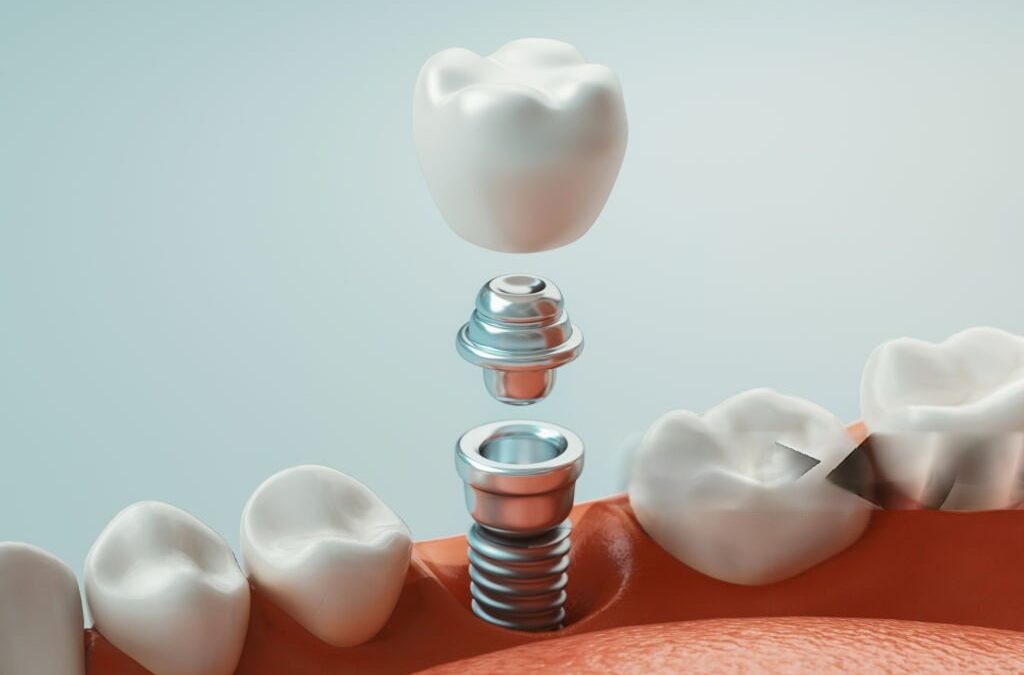 Dental Implants in Walnut – Your Permanent Solution for Missing Teeth