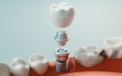 Dental Implants in Walnut – Your Permanent Solution for Missing Teeth