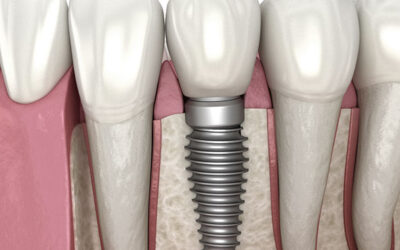 Everything You Should Know About Dental Implants